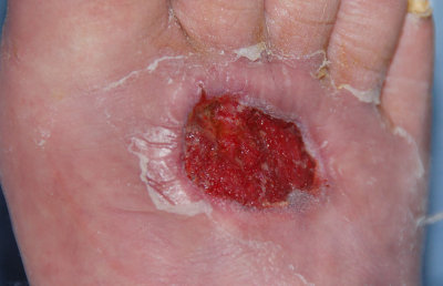 Open Wound After Surgery