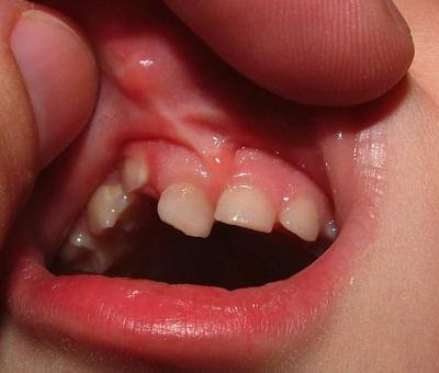 Finally my last tooth slides into place! To bad theyre not my permanent ones!