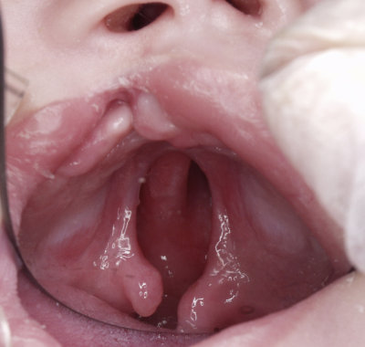 Another treatment option for infants born with clefts of the primary and secondary palate is Nasal Alveolar Molding. Pre-Surgical Nasal Alveolar Molding is a method of treatment that reshapes the infants nose without surgery through the use of a custom made orthopedic denture plate. 