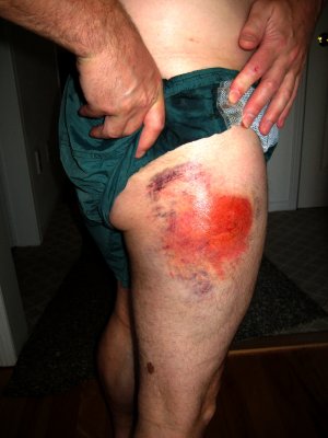 Pete's road rash 21st May