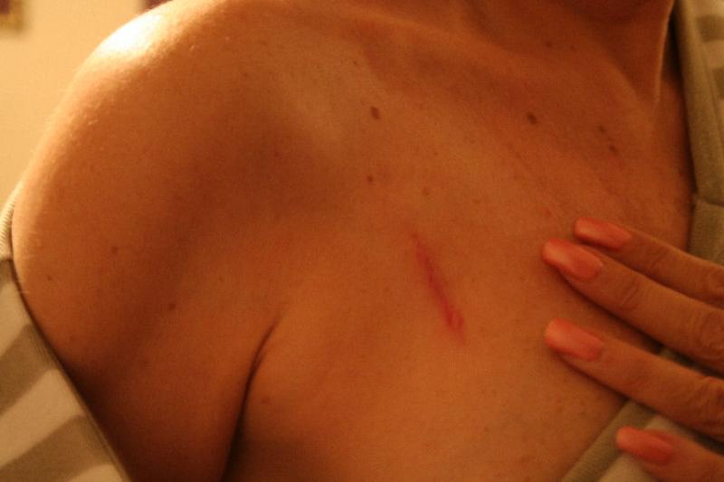 MY CHEMOTHERAPY PORT SCAR