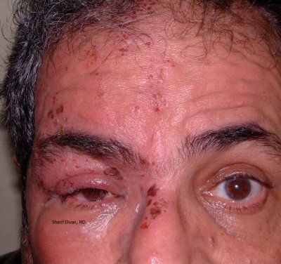 11.Herpes Zoster Ophthalmicus