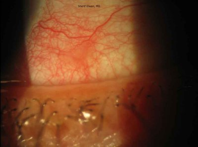 23.Conjunctival Phlycten with Staphylococcal Blepharitis