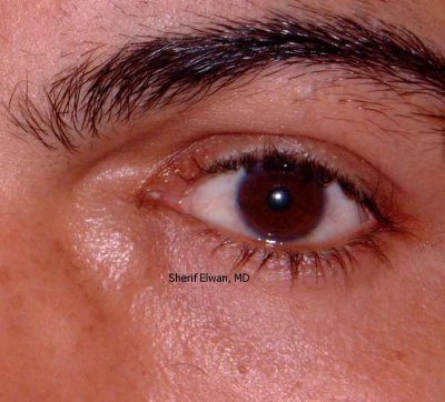31.Lacrimal Mucocele