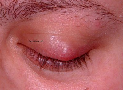 35.Infected Upper Lid Chalazion