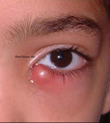 45.Lower Infected Chalazion