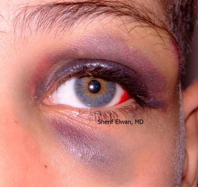 61.Black Eye due to Blunt Trauma