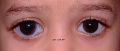 24.Bilateral Primary Congenital Glaucoma: Buphthalmos