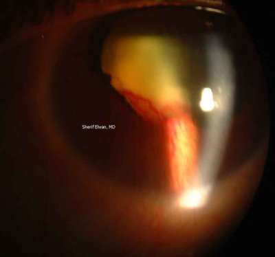 69.Iris Neovascularization with Neovascular Membrane Extending Over Crystalline Lens