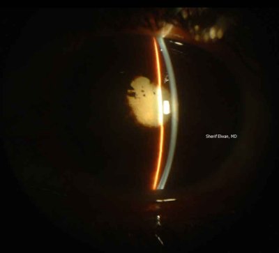 71.Complicated Cataract, Posterior Synechiae, Festooned Pupil