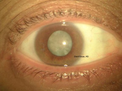73.Mature Senile Cataract