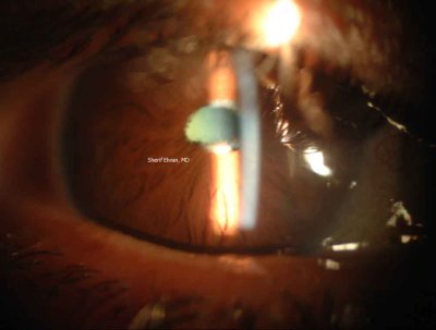 74.Cataract with Pseudoexfoliation