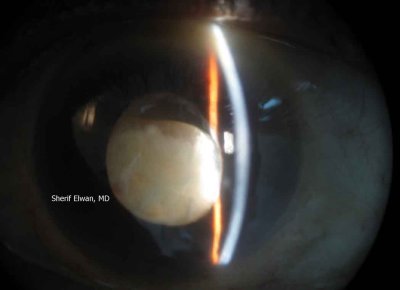 75.Subluxated Mature Catactous Lens