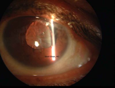 76.Subluxated Clear Lens - Corneal Stitches
