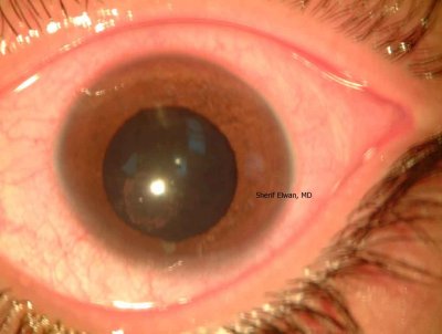 77.Posterior Cortical Cataract