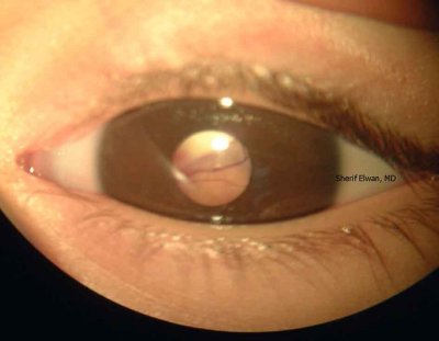 36.Retinoblastoma (Amourotic Cat's Eye)