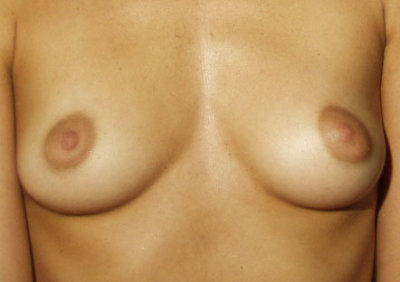 Breast Breast 007