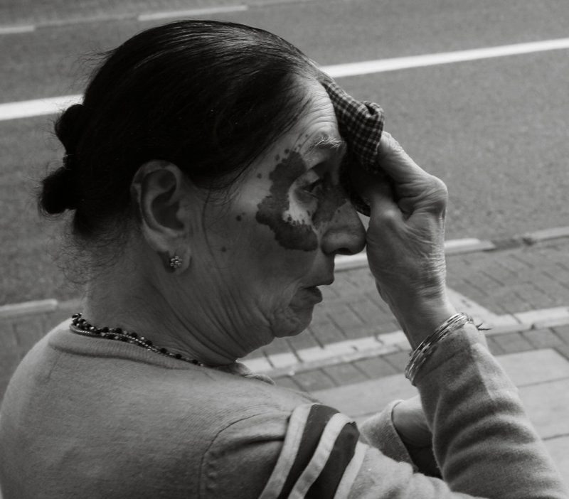 August 18  2008: <br> Scarred