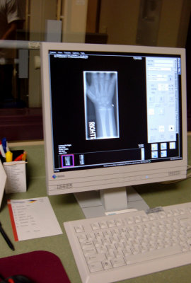 Buckle Fracture X-Ray