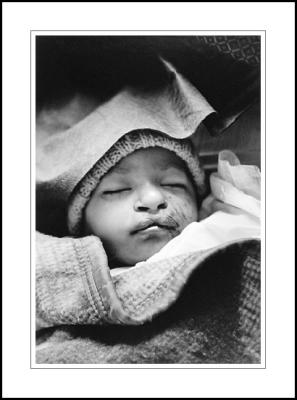 Patient, post-op, Banepa Clinic, Nepal, 2001