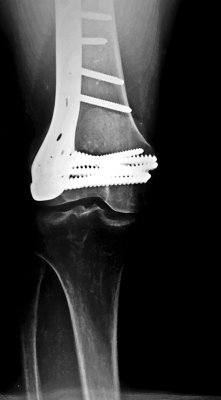 left knee