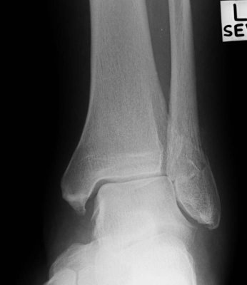 Fractured ankle X-Ray.jpg