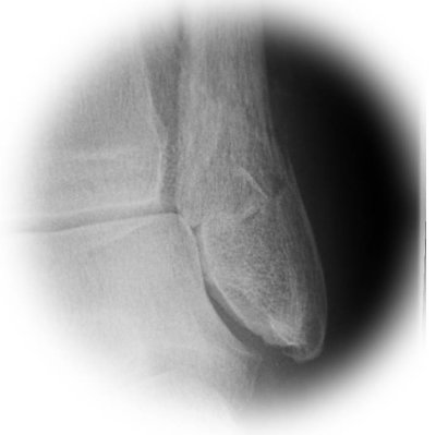 Fractured ankle X-Ray 02.jpg