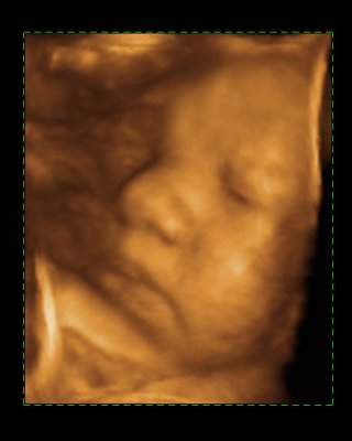 Fetal Photos