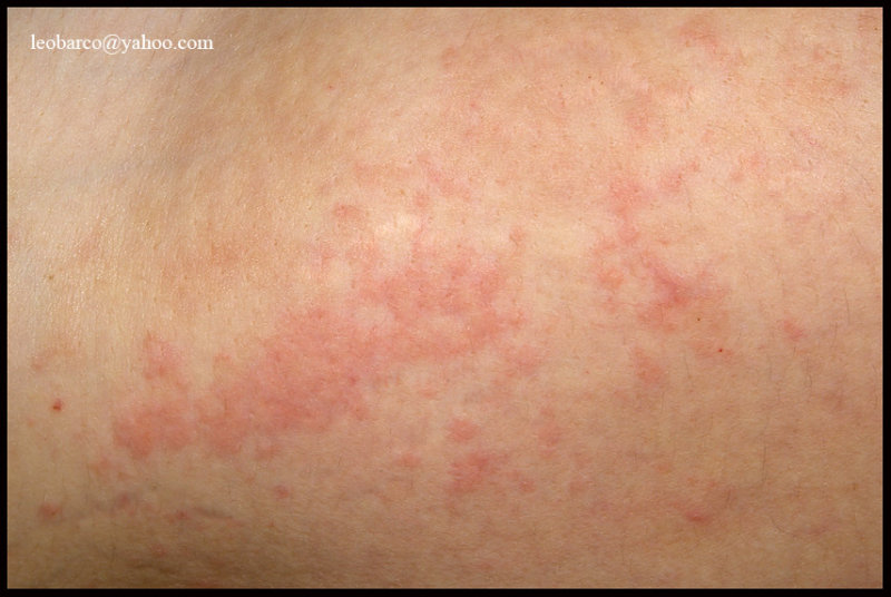 URTICARIA.JPG