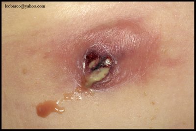 INFLAMED AND RUPTURED EPIDERMAL CYST.jpg