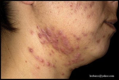 ACNE WORSENING DURING EARLY PREGNANCY.JPG