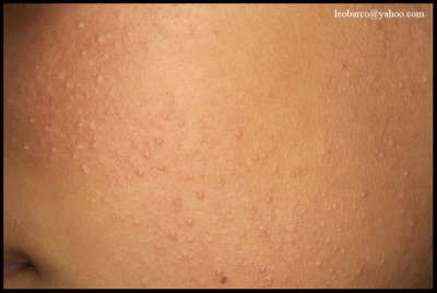 KERATOSIS PILARIS FACIEI.JPG