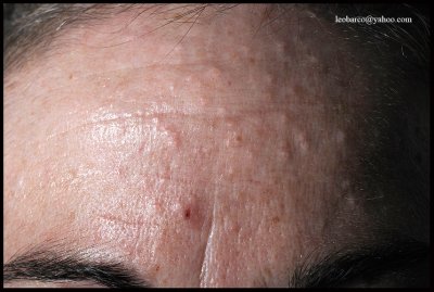 SEBACEOUS HYPERPLASIA.jpg