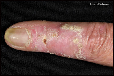 RADIATION DERMATITIS_02.jpg