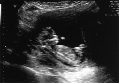 Ultrasound - Jan 11, 2010 - #1