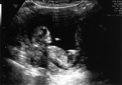 Ultrasound - Jan 11, 2010 - #2
