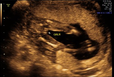Ultrasound - Feb 19, 2010 - #1