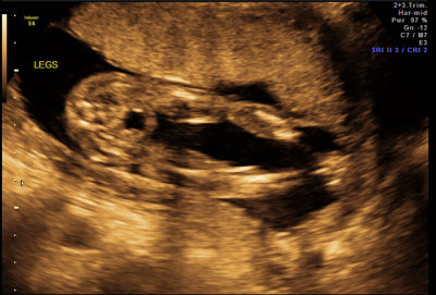 Ultrasound - Feb 19, 2010 - #2