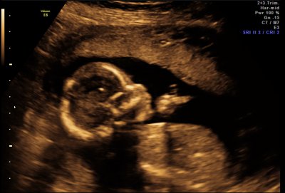 Ultrasound - Feb 19, 2010 - #4