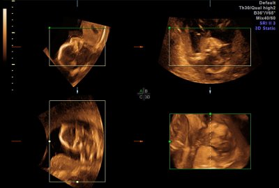 Ultrasound - Feb 19, 2010 - #6