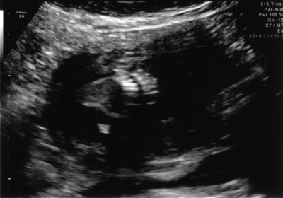 Ultrasound - Mar 12, 2010 - #1.jpg
