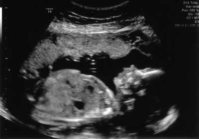 Ultrasound - Mar 12, 2010 - #2.jpg