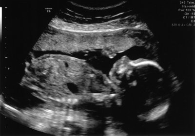 Ultrasound - Mar 12, 2010 - #3.jpg