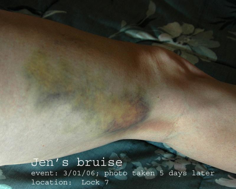 3-01-06 Jen bruise.jpg