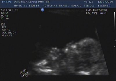 12 weeks and 4 days