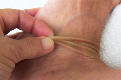 ACA Thin skin on foot pinching it-no. 10.jpg