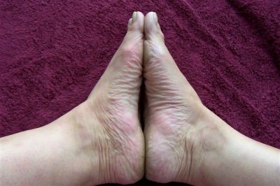 ACA both feet insoles red rash and discoloration-no. 3.jpg