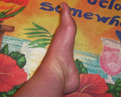 ACA swelling discoloration foot-no. 2.jpg