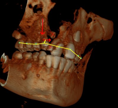 The teeth with the X's will be taken out. Then I will be given special braces to shift the tooth with the right arrow to the right to make room for the other one with the down arrow grow in place. The black spot where the teeth are extracted will be replaced with bone harvested from my hip bone.