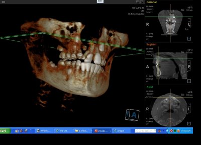 This is a 3d rendering of my teeth. in the next slide you will see the plan of action to give me my smile back.